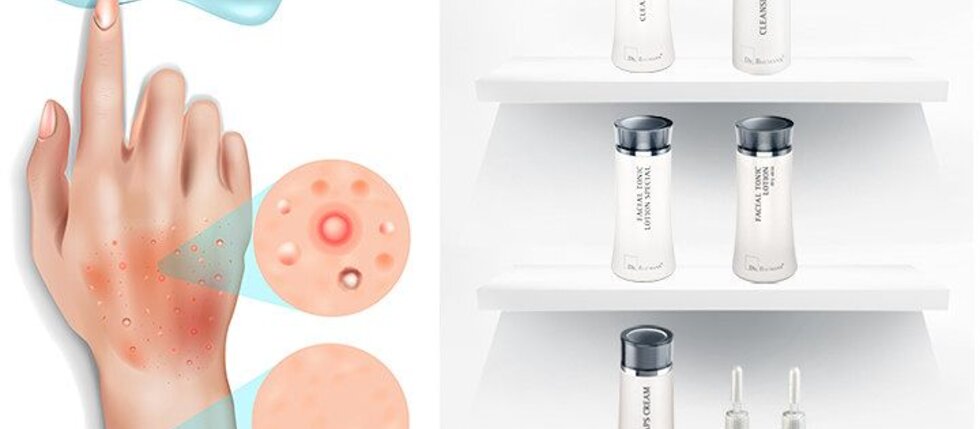 Iritačná dermatitída a ako ju ošetrovať Iritačná dermatitída a ako ju ošetrovať